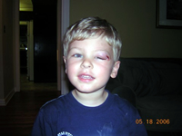 Tommy gets a bump at school...